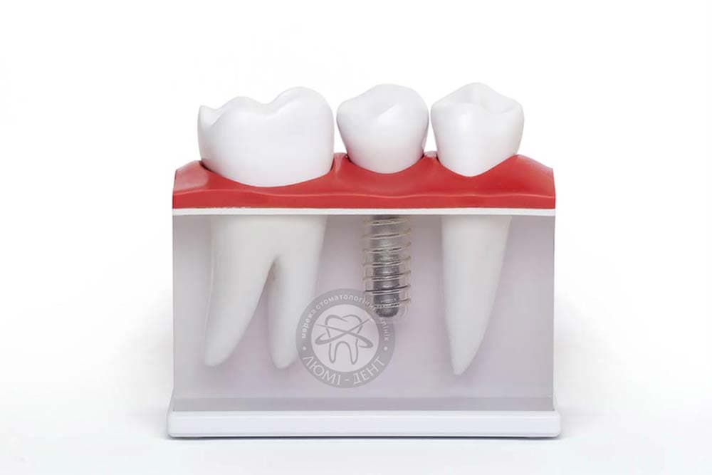 Стоматологія лікування зубів фото Люмі-Дент