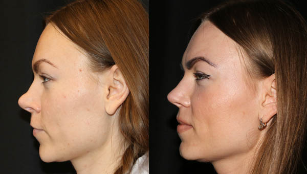 rhinoplasty 56