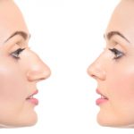 rinoplastika do i posle