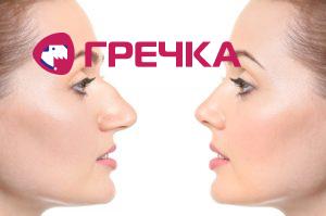 rinoplastika do i posle