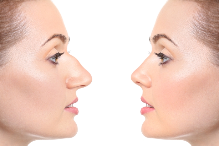 rinoplastika do i posle